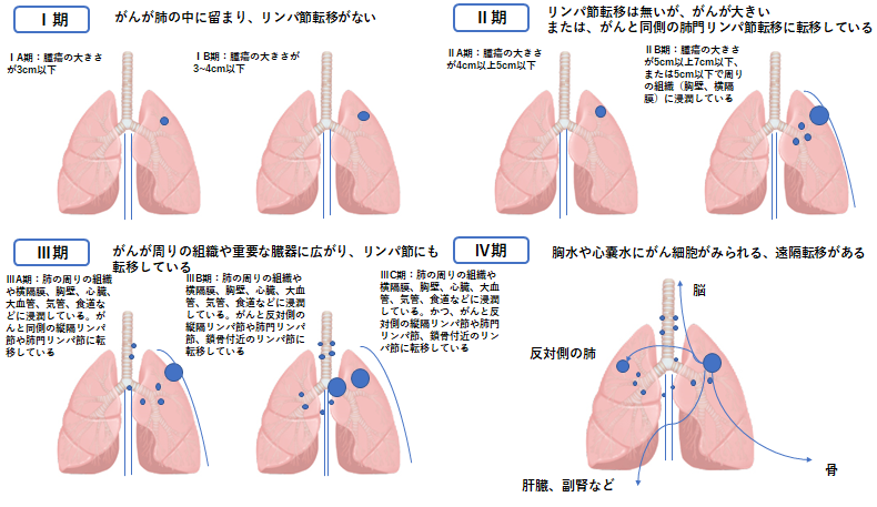 肺がん 背中 の 痛み ステージ